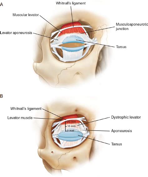 Lower Eyelid Anatomy · Skin, Muscle, Tarsal Plate,, 42% OFF