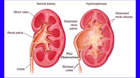 Renal Pelvis Location In Body