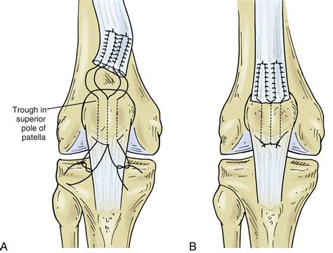 Surgical Treatment of Traumatic Quadriceps and Patellar Tendon Injuries of the Knee ...