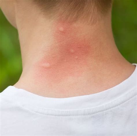 Mosquito Bite Allergy Symptoms - Mosquito Bite Reaction Meaning