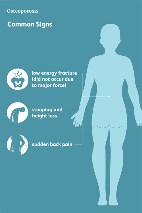 Osteoporosis: Signs, Symptoms, and Complications