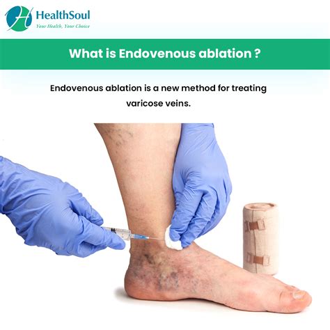 Endovenous Ablation: Indications and Risks – Healthsoul