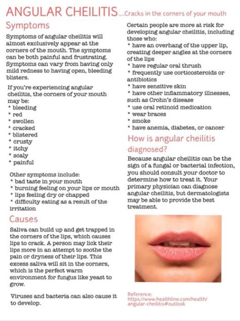 What Is Angular Cheilitis Symptoms Causes Treatment – NBKomputer