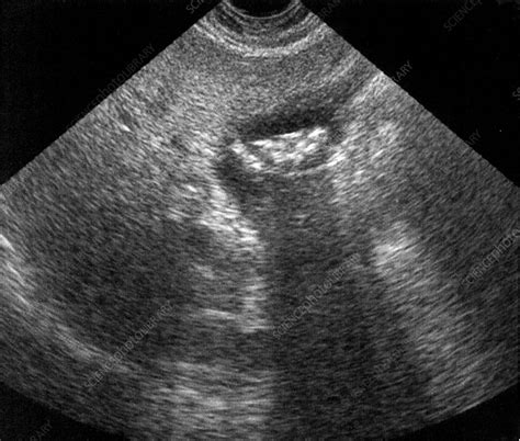 Gallstones, ultrasound scan - Stock Image M165/0227 - Science Photo Library