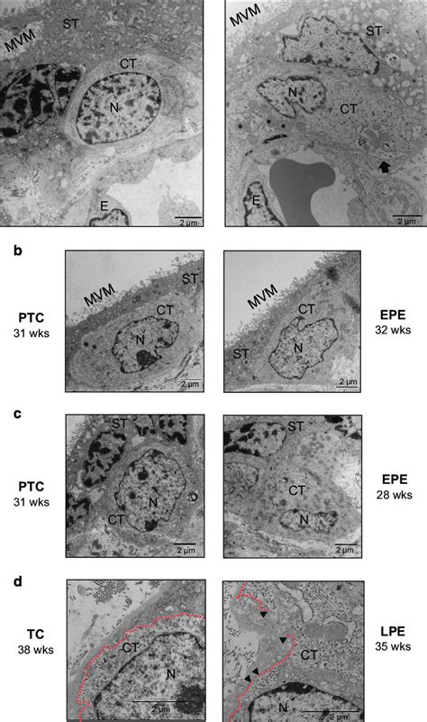 Preeclampsia is associated with necroptotic cytotrophoblast cell ...