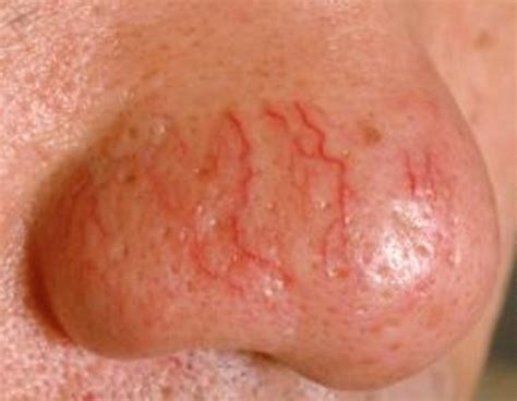 Telangiectasia - Pictures, Symptoms, Causes, Treatment | HubPages