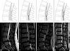 Clinical Significance of Redundant Nerve Roots of the Cauda Equina in Spine MRI