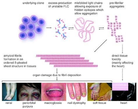 Update on treatment of light chain amyloidosis | Haematologica