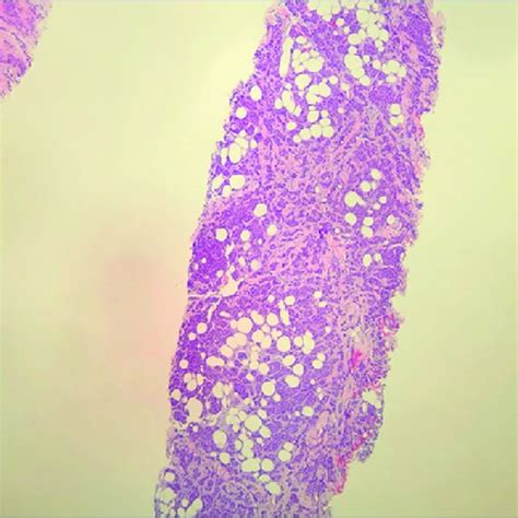 Right breast mass biopsy at 9 o'clock position. Right areola ...