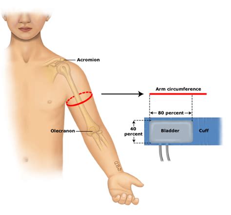 How to select correct cuff size for measuring blood pressure ...