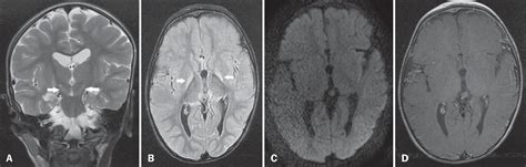 Kernicterus Mri