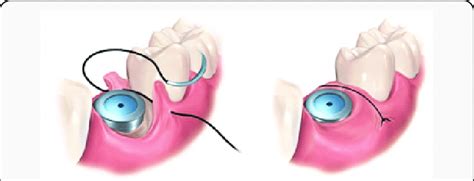 Interrupted simple suture. | Download Scientific Diagram