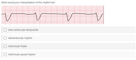 Accelerated Idioventricular Rhythm ECG Stampede, 54% OFF