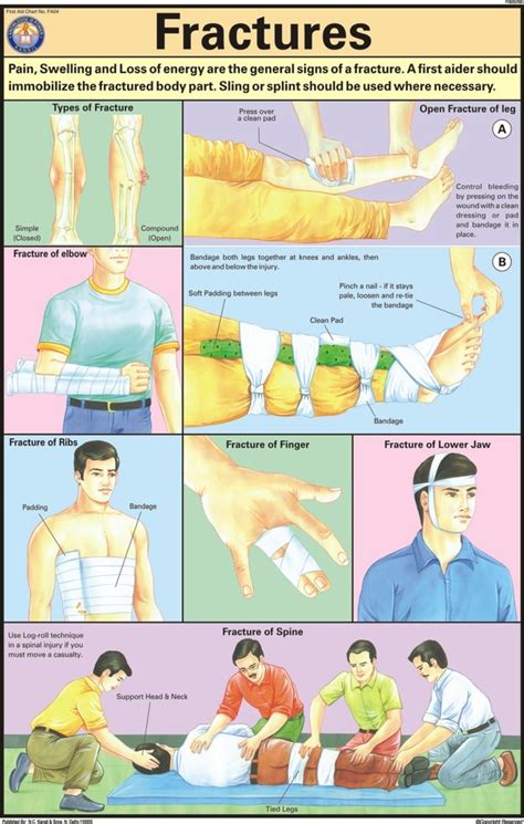 Laminated Paper Fractures For First Aid Chart at Rs 96/piece in New Delhi | ID: 2894227797