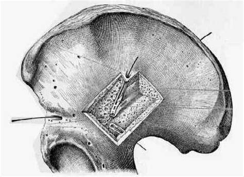 Posterior Iliac Crest Graft Harvest : Wheeless' Textbook of Orthopaedics