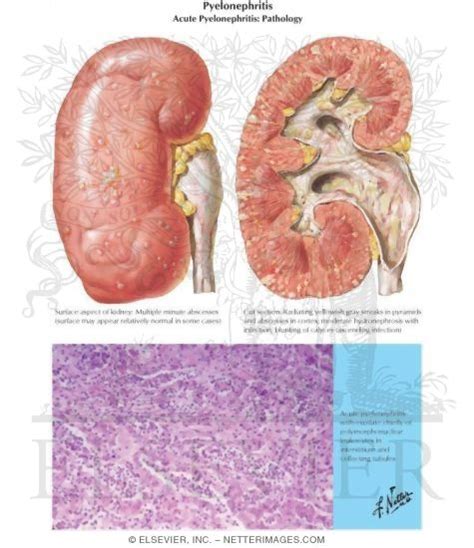 Acute Pyelonephritis: Pathology