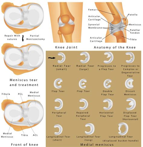 Medial Meniscus Tear