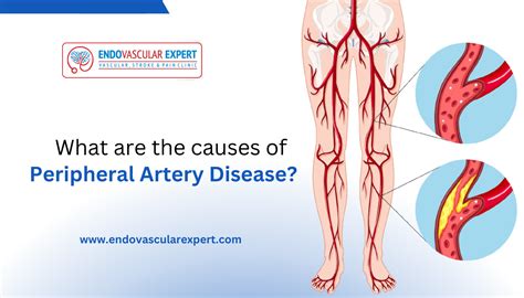 What are the causes of Peripheral Artery Disease? | Dr. Nikhil Bansal