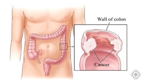 Study Shows CBD May Effectively Treat Colon Cancer