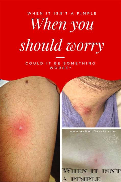 When A Pimple Is Something Worse: Could It Be MRSA? | Fungal infection ...