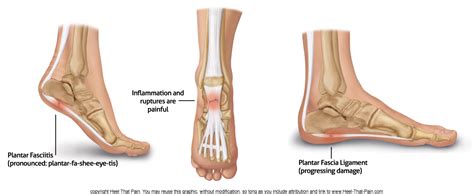 Plantar Fascia Ligament & Pain Conditions | Heel That Pain