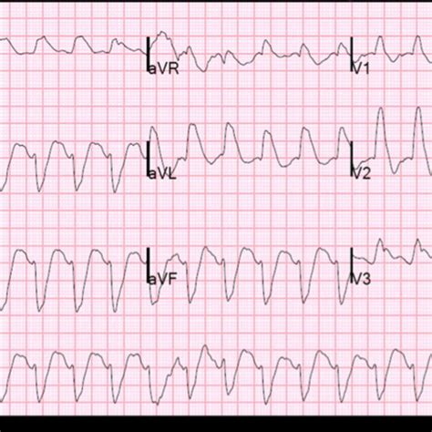 Podcast #135: Ventricular Tachycardia - The Emergency Medical Minute