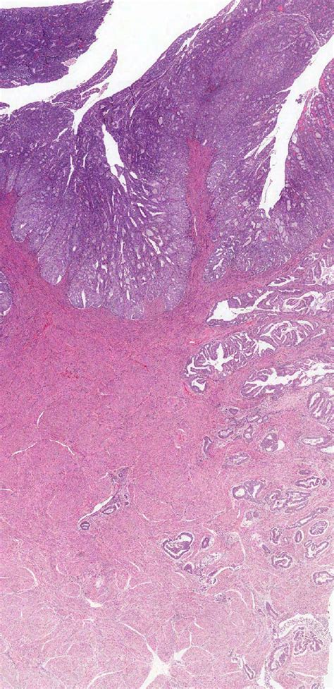 Pathology Outlines - IFITM1