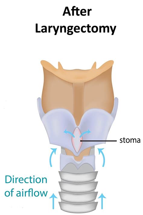 Laryngectomy Anatomy