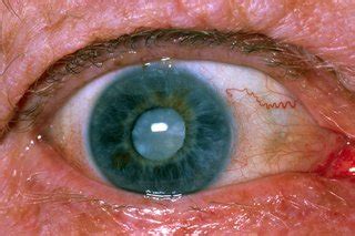 Age-related cataracts - NHS