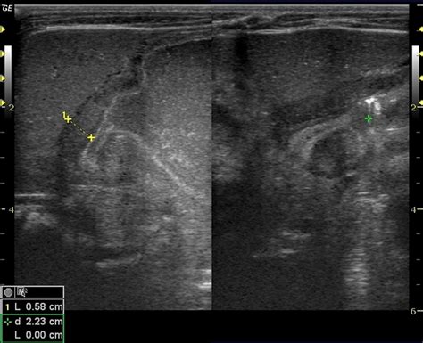 Pyloric Stenosis - Causes, Symptoms, Complications, Treatment