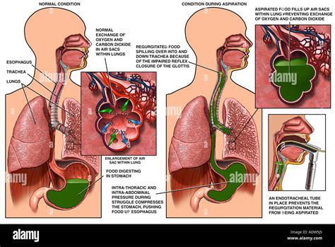 Aspiration of Stomach Contents Due to Choke Hold Stock Photo: 7711972 - Alamy