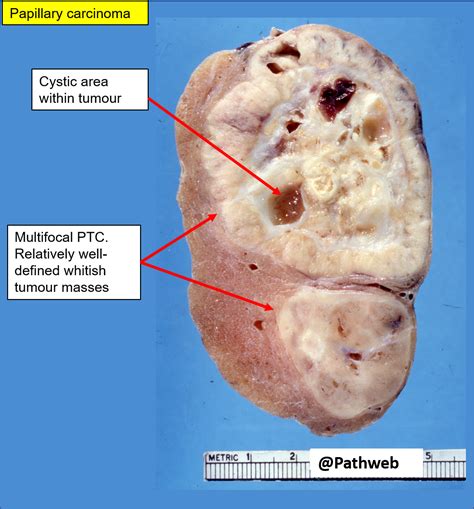 Papillary Thyroid Carcinoma Gross