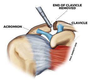 Acromioclavicular Joint Arthritis or Arthropathy | Murdoch Orthopaedic Clinic