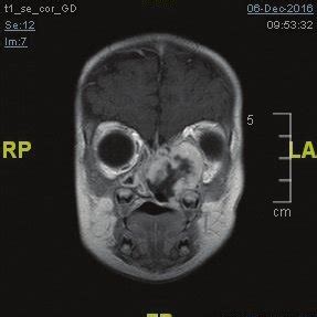 A. MRI of brain and paranasal sinuses in coronal view (3A) and axial... | Download Scientific ...