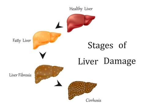 Liver Damage Could Result From Mix Of CBD & Acetaminophen