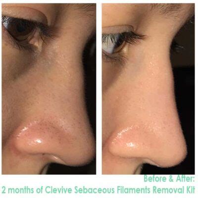 The Sebaceous Filaments Removal Kit – Clevive