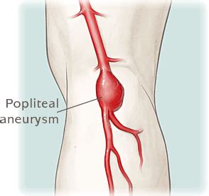 Popliteal Aneurysm | UVA Health