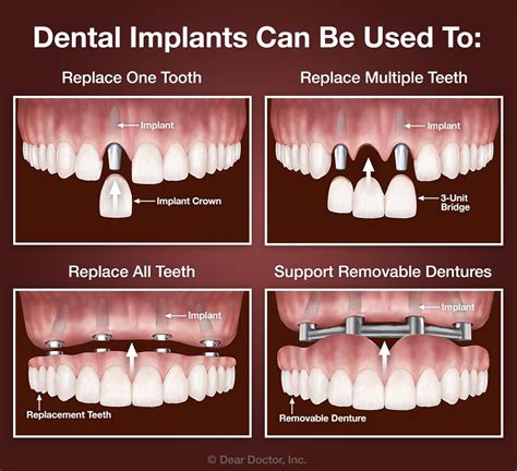 FAQs about Dental Implants | J. A. Lewandowski, D.D.S. | Leawood Kansas