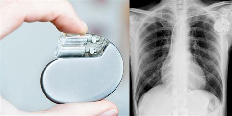 Pacemaker and Implantable Defibrillator | | Dr. Paul Ong