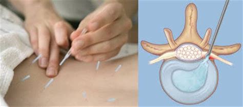 Acupuncture for Back Pain - Philadelphia, PA Patch