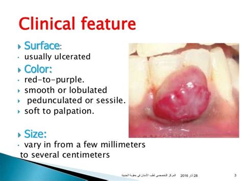 Oral pyogenic granuloma