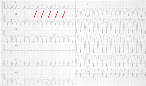 Pulseless ventricular tachycardia differential diagnosis - wikidoc