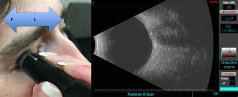 Ocular Ultrasound: A Quick Reference Guide for the On-Call Physician