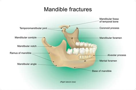 What are Mandibular Fractures?