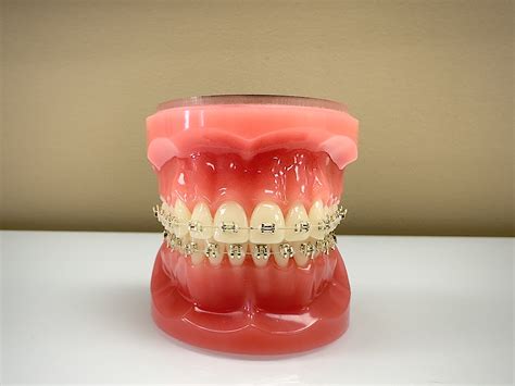 Gold Braces in Knoxville, TN | Knoxville Orthodontics | Gold Braces in ...