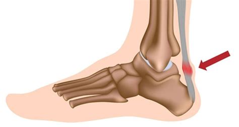 Achilles Tendonitis - St. Augustine - All About Feet & Legs