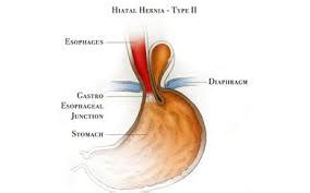 Laparoscopic Paraesophageal Hiatal Hernia