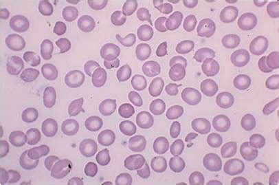 Thalassemia - wikidoc