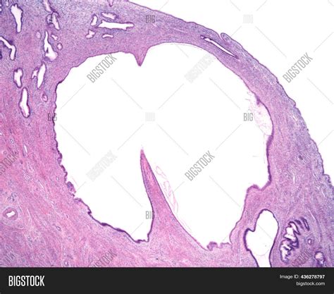 Nabothian Cysts Large Image & Photo (Free Trial) | Bigstock