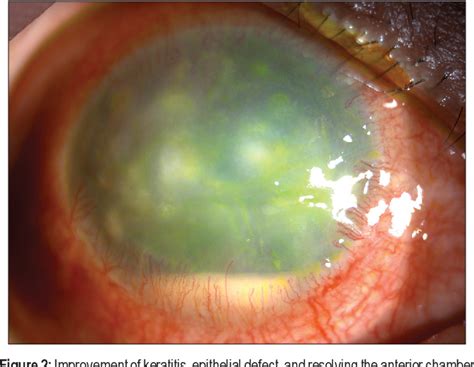 Figure 1 from Herpes zoster keratouveitis with hypopyon and hyphema ...